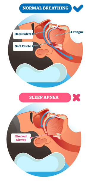 In normal breathing, the airway is open; in Obstructive Sleep Apnea, the airway is blocked by the tongue and soft palate against the back of the throat.