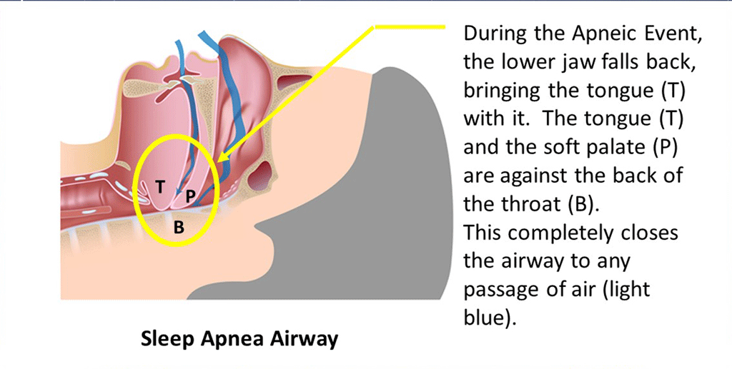 Sleep Apnea Airway