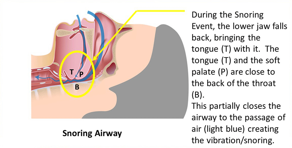 Snoring Airway